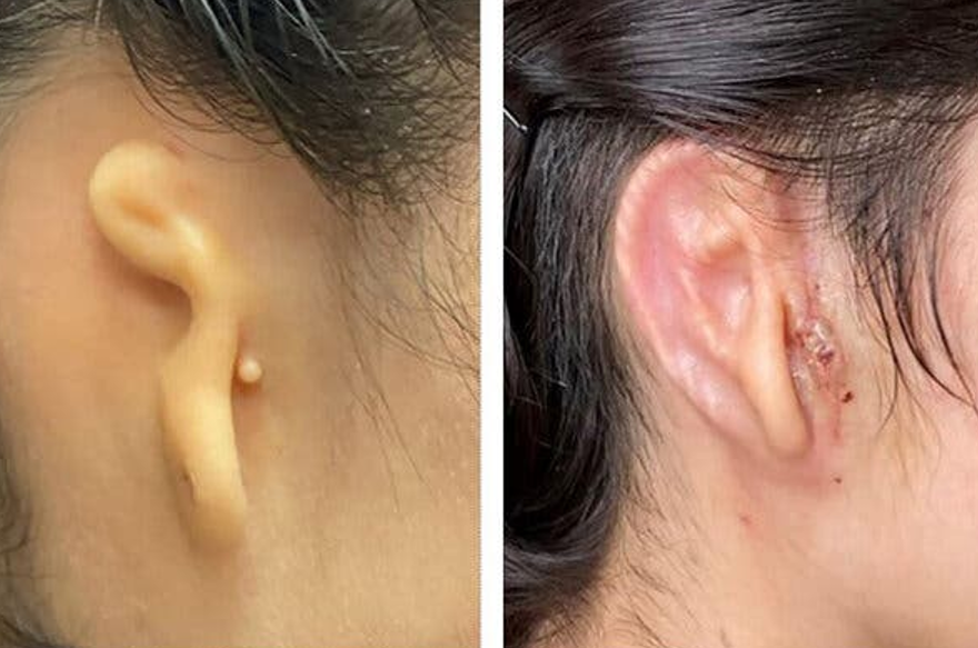  پیوند گوش تولید شده با سلول های انسانی توسط تکنولوژی چاپگرهای سه بعدی 